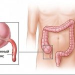 Blood test for appendicitis: purpose, blood sampling algorithm, testing, interpretation of the result and consultation with a doctor