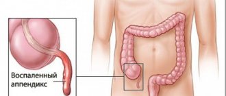 Blood test for appendicitis: purpose, blood sampling algorithm, testing, interpretation of the result and consultation with a doctor