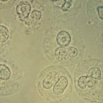 protein and leukocytes in urine