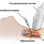 Биопсия щитовидной железы проведение и подготовка к процедуре