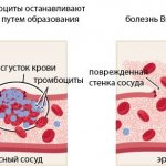 Willebrand&#39;s disease