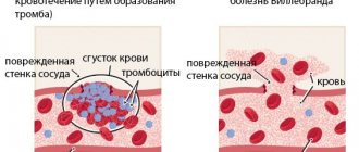 Willebrand&#39;s disease