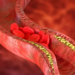 What is atherosclerosis?