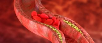 What is atherosclerosis?