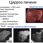 Cirrhosis of the liver on ultrasound