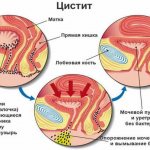 Cystitis