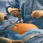 IVF after laparoscopy