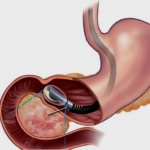 Endosonography of the stomach