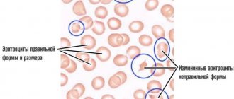 red blood cells in poikilocytosis