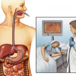 Esophagoscopy