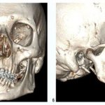 photo CT scan of the upper and lower jaw