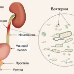 Hematuria infection diagram