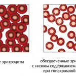 Hypochromia in a general blood test in a child, women, men, causes, treatment