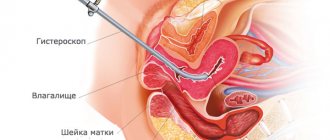 How to prepare for hysteroscopy of the uterus