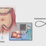 Colonoscopy during menstruation