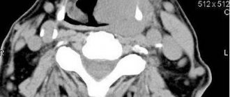 Computed tomogram of the larynx - photo