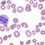 Кровь при B12-дефицитной анемии