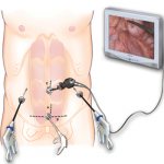 Laparoscopic surgery