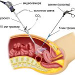 laparoscopy