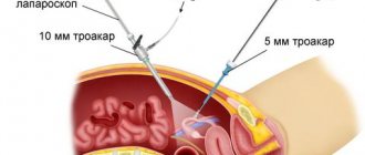 laparoscopy