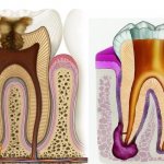 treatment of dental granuloma