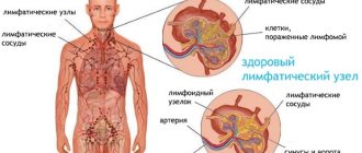 Lymphoma in adults. Causes, symptoms and treatment by stages, photos, tests 