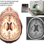 Magnetic resonance imaging (MRI) of the brain