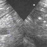 Myometrium of increased echogenicity - what is it?