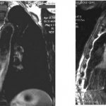 MRI of the lungs and bronchi, which shows