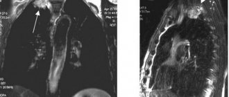 MRI of the lungs and bronchi, which shows