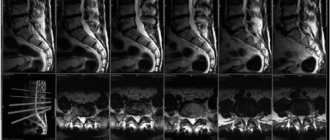 MRI of the lumbosacral spine: how to prepare for the procedure