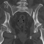 MRI of the pelvic bones.jpg