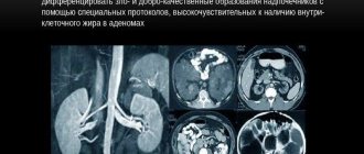 MRI