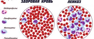 Acute myeloblastic leukemia