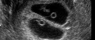 fertilized egg with twins on ultrasound