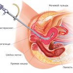 preparation for hysteroscopy