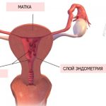 Polyps in the uterus