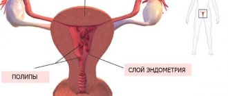 Polyps in the uterus