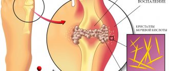 Elevated uric acid