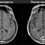 Преимущества МРТ с контрастом