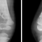 With osteomyelitis, the infection process covers the entire bone, including the bone marrow