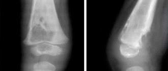 With osteomyelitis, the infection process covers the entire bone, including the bone marrow