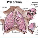 Lung cancer on the diagram