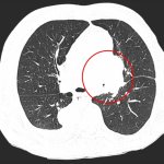 Lung cancer on CT scan