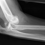 Рентген локтевого сустава: снимки локтя