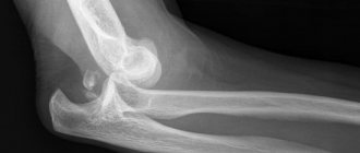 Рентген локтевого сустава: снимки локтя