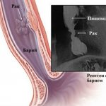 X-ray of the esophagus with barium