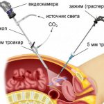 how much does laparoscopy cost