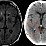 MRI scan of the brain