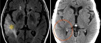 MRI scan of the brain